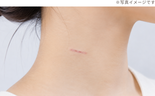 傷跡を最小限に抑える美容的配慮
