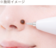 レーザー治療