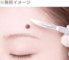 切除手術