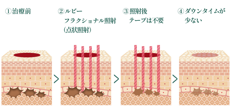 安全で均一な照射を実現