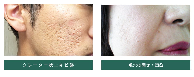 クレーター状ニキビ跡・毛穴に対応