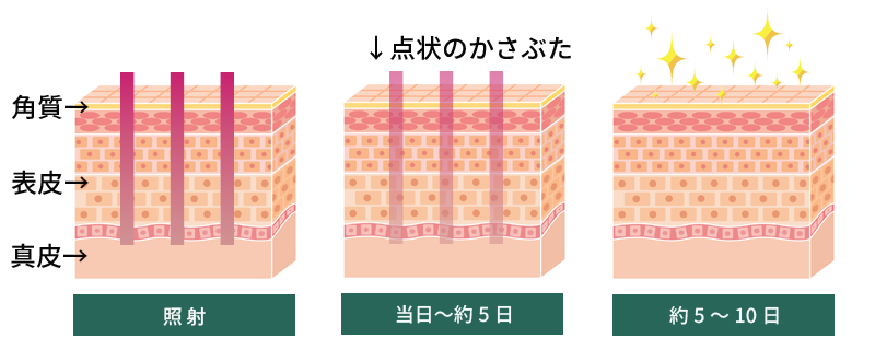 微細なレーザー照射
