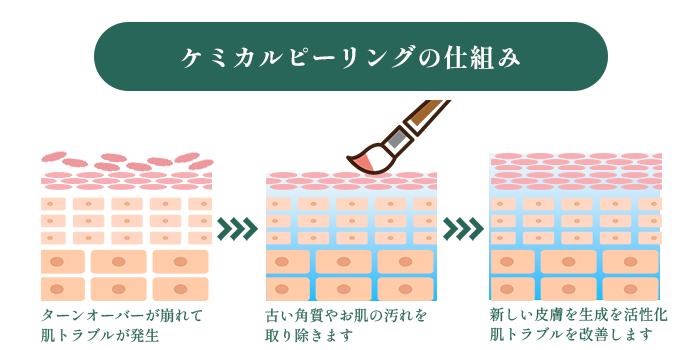 ケミカルピーリングの仕組み