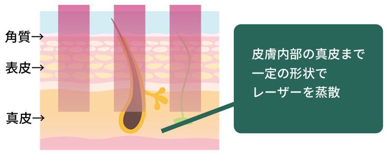 新皮層まで熱刺激を届ける治療