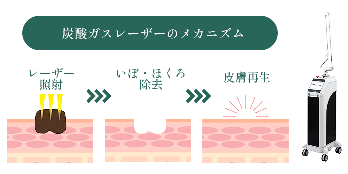 炭酸ガスレーザー（CO2レーザー）のメカニズム