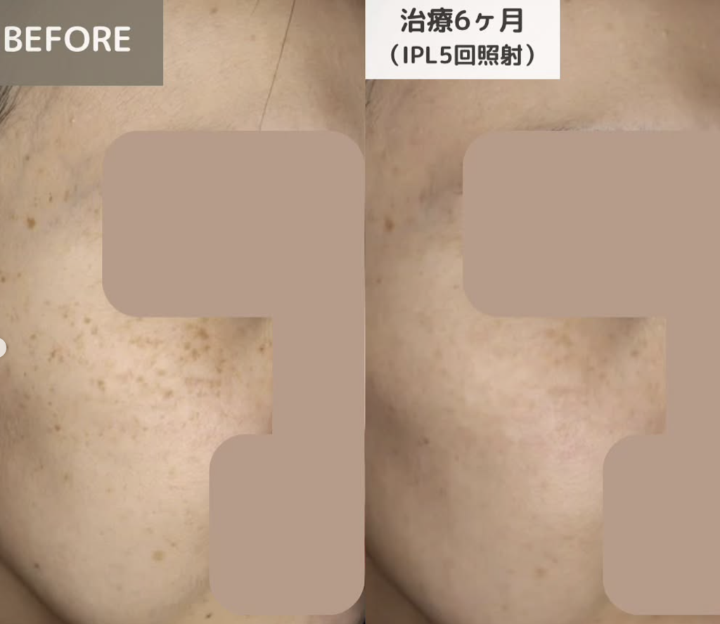 フォトフェイシャル症例