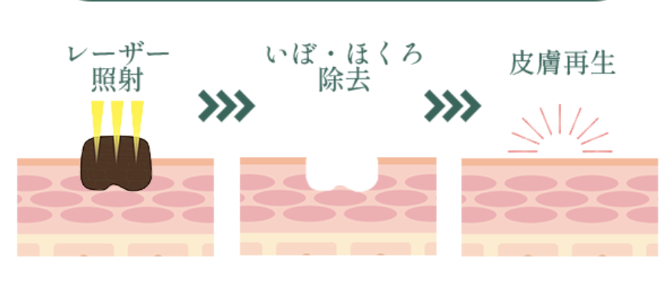 レーザー