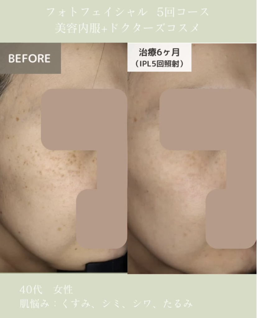 フォトフェイシャル症例