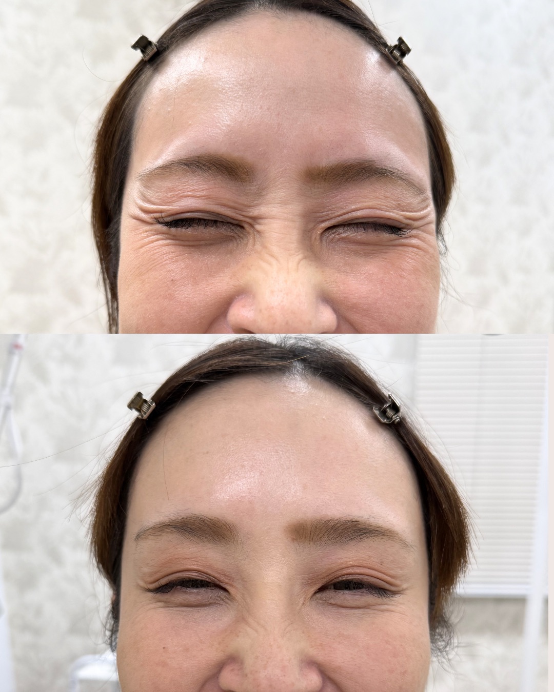 バニーライン（鼻すじのシワ）のビフォーアフター｜ボツリヌストキシン注射
